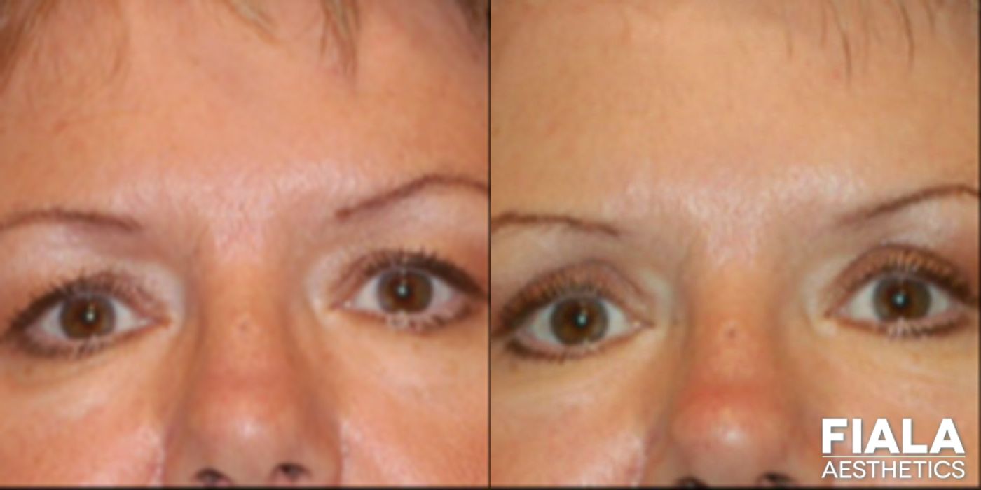 Before and after Eyelid Lift case 13881