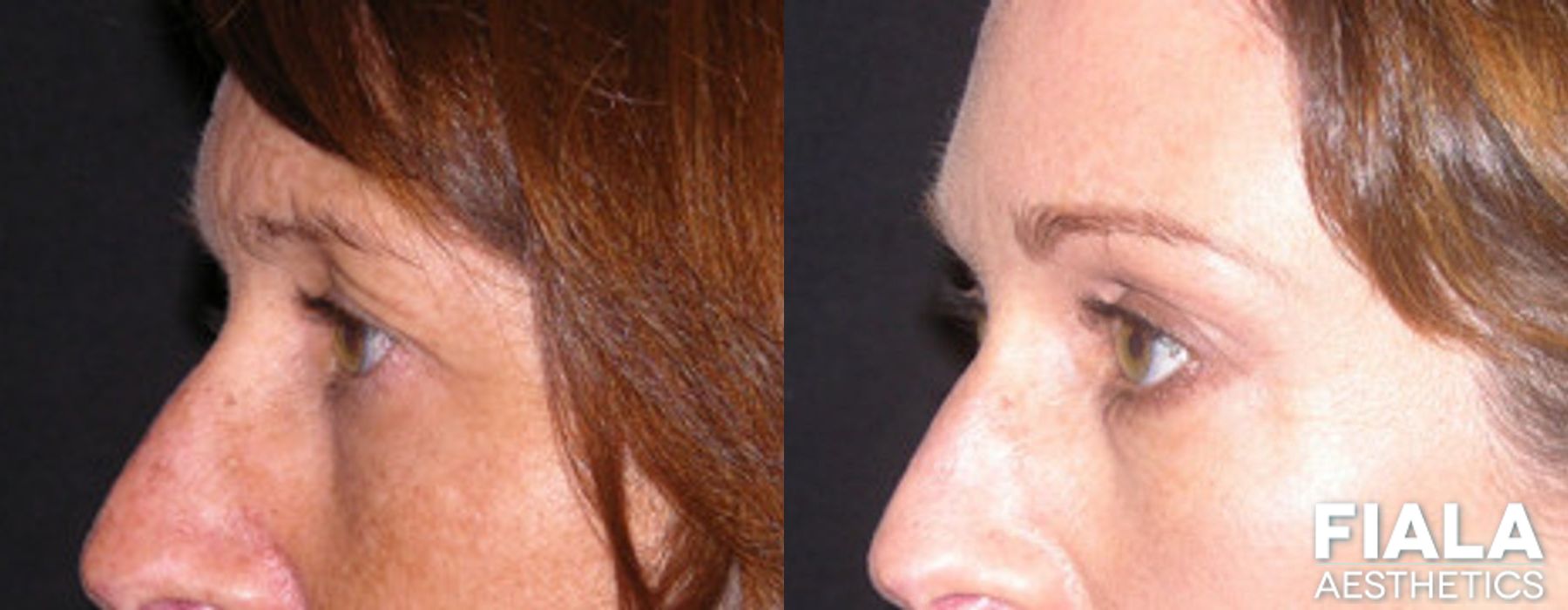 BOTOX Cosmetic - Thumbnail 2