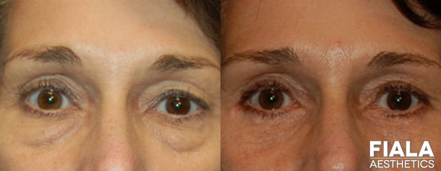 Eyelid Lift - Thumbnail 2