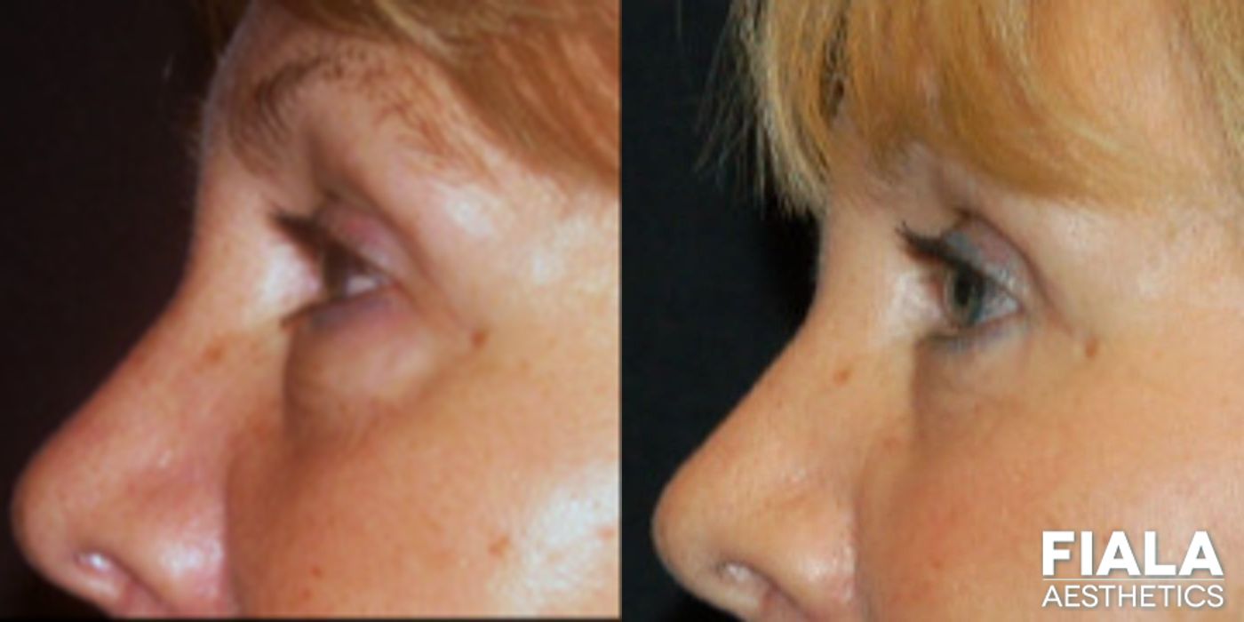 Before and after Eyelid Lift case 13867 - Angle 2