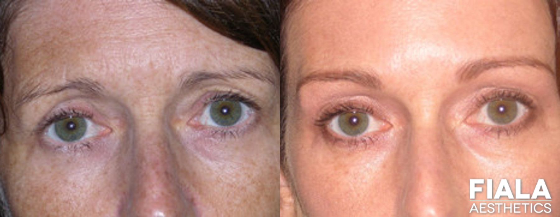 BOTOX Cosmetic - Case 9009