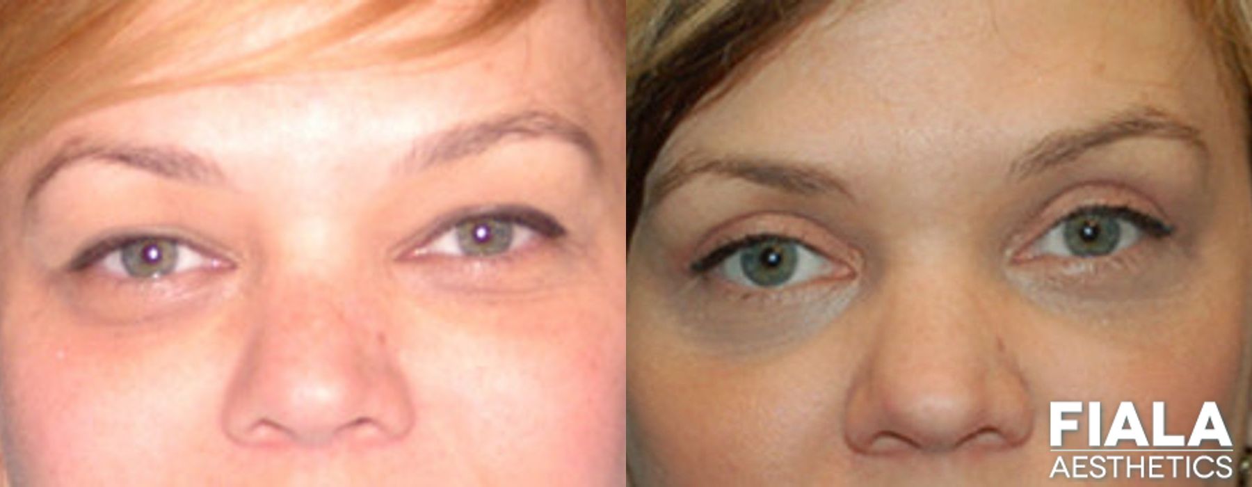 Eyelid Lift - Case 9231