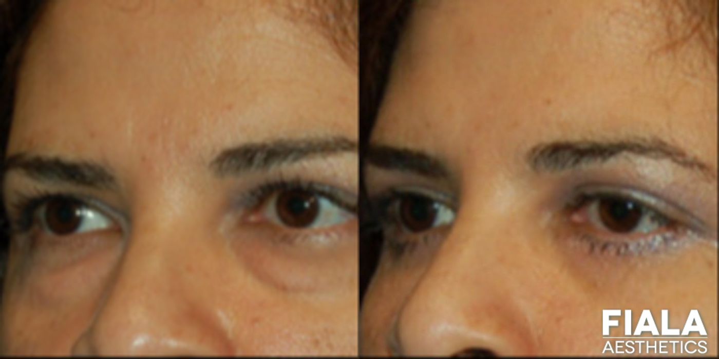 Eyelid Lift - Case 9235