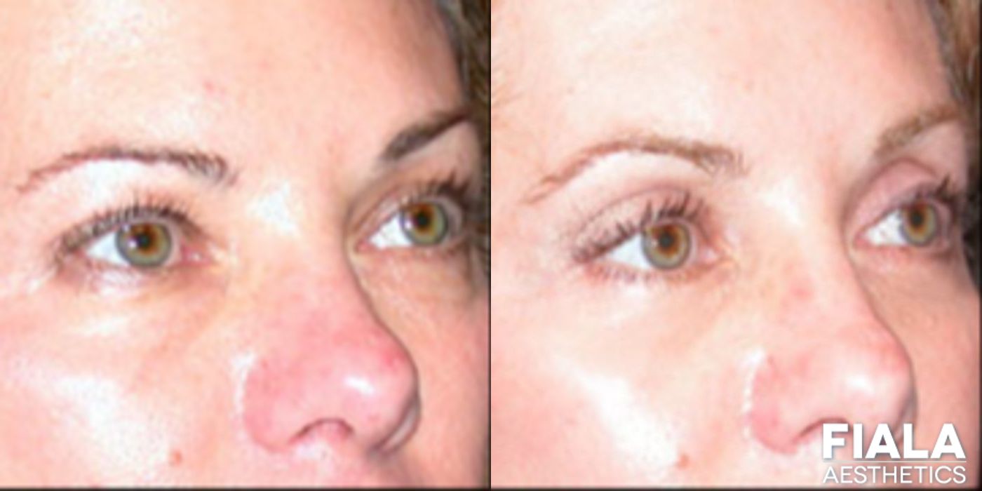 Eyelid Lift - Case 9253