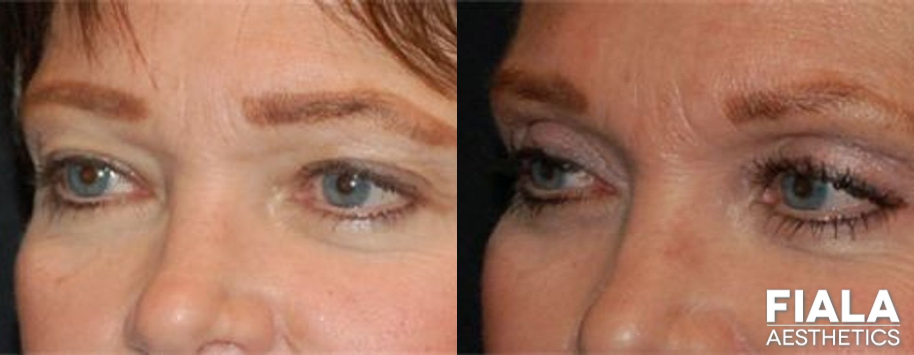 Before and after Eyelid Lift case 13870 - Angle 2