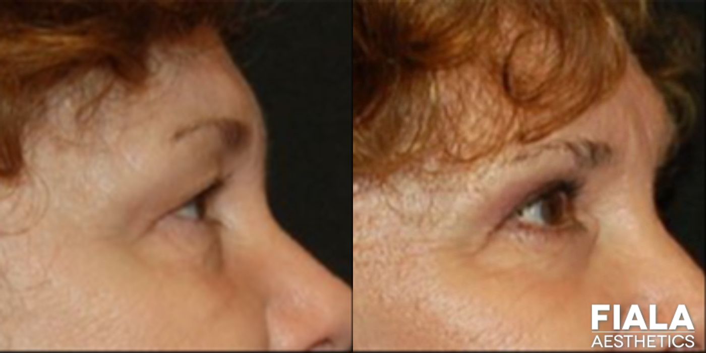 Eyelid Lift - Thumbnail 2