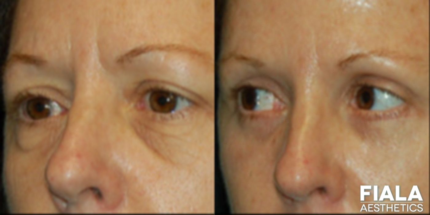 Eyelid Lift - Thumbnail 2