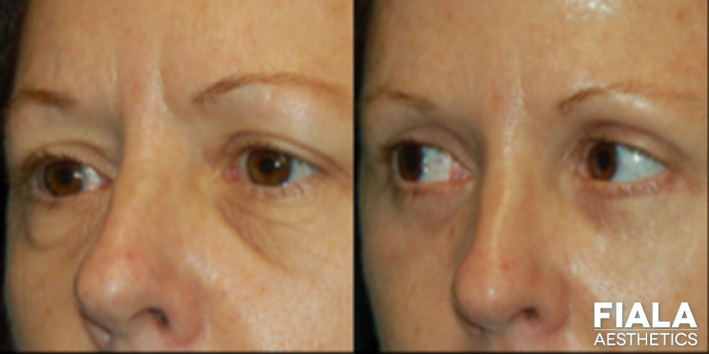 Before and after Eyelid Lift case 13868 - Angle 2