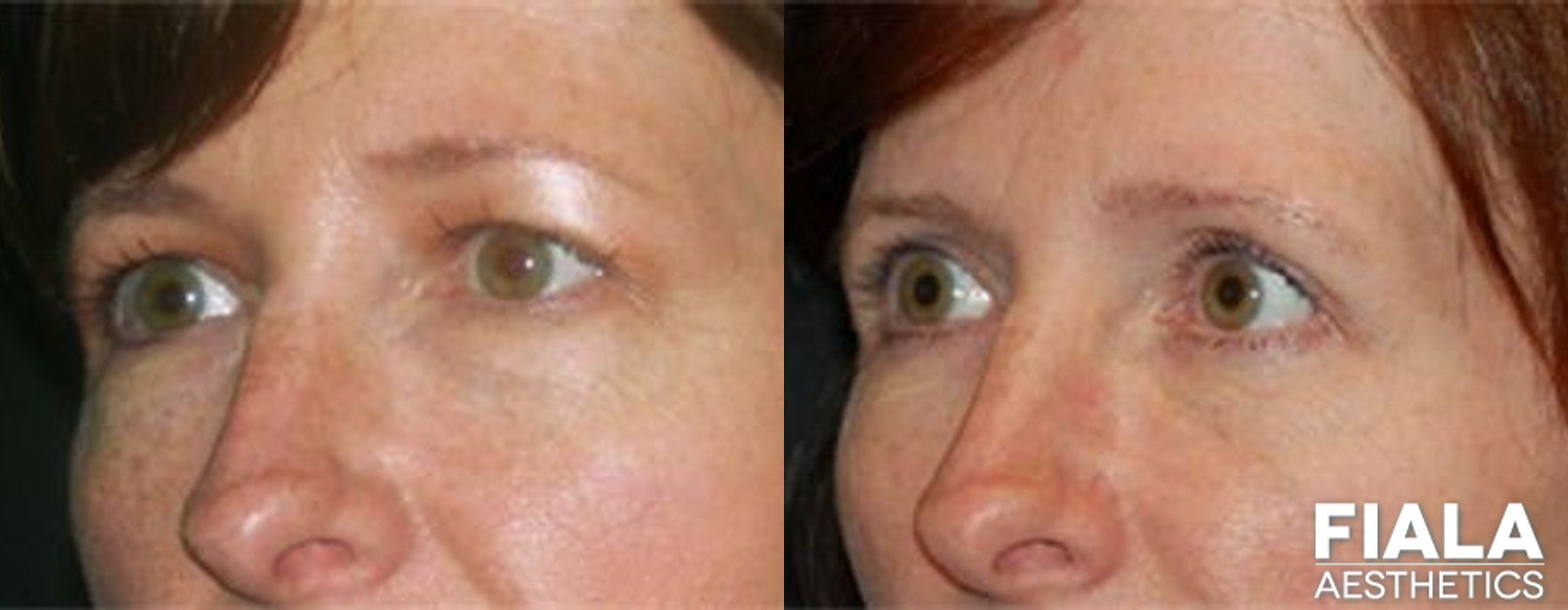 Eyelid Lift - Thumbnail 2