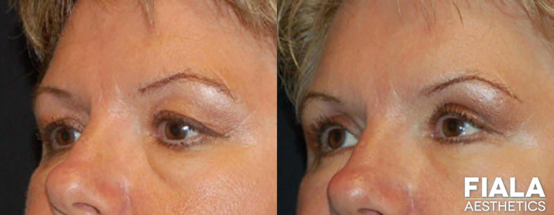 Eyelid Lift - Thumbnail 2