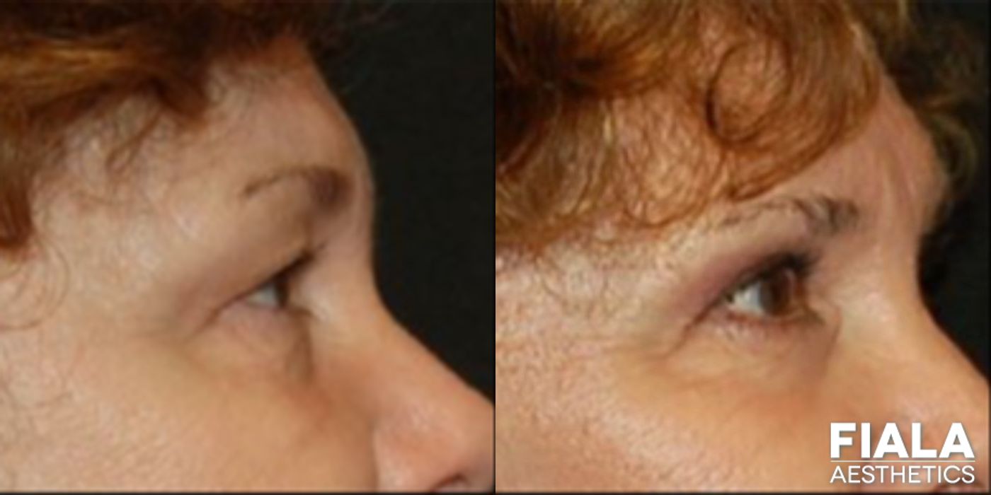 Before and after Eyelid Lift case 13871 - Angle 2