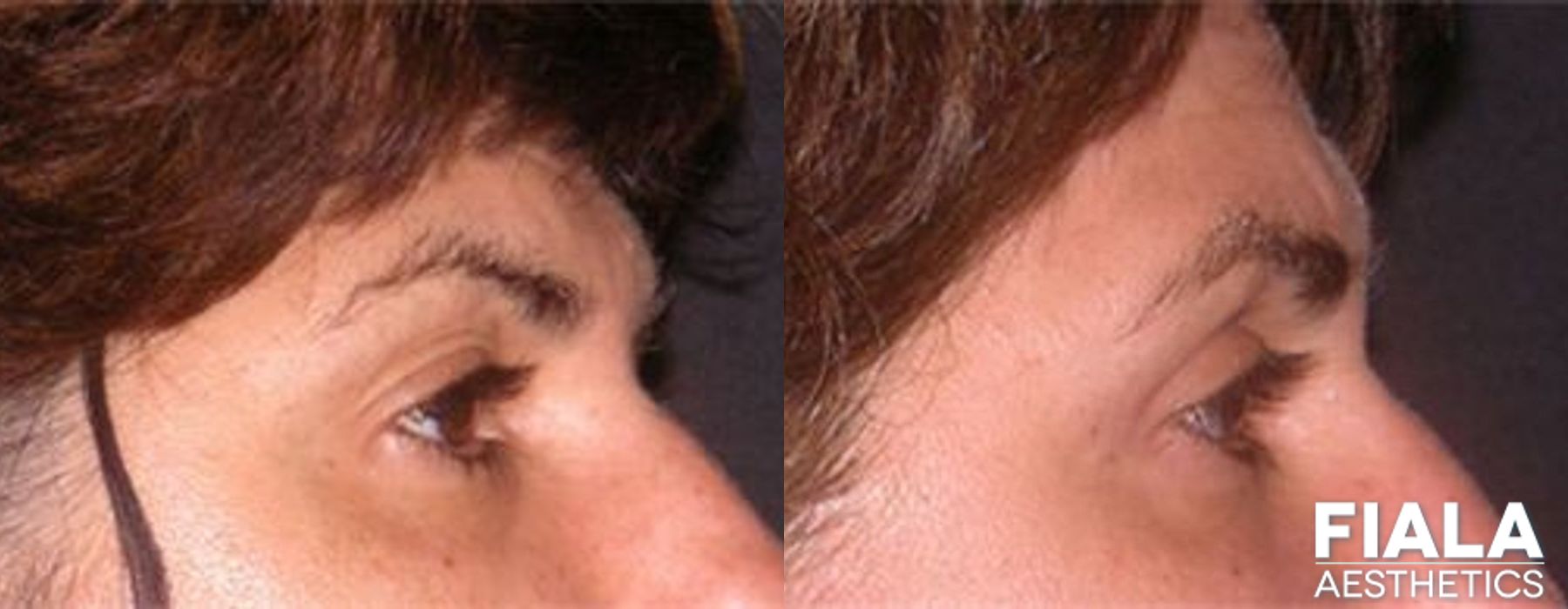 Eyelid Lift - Thumbnail 2