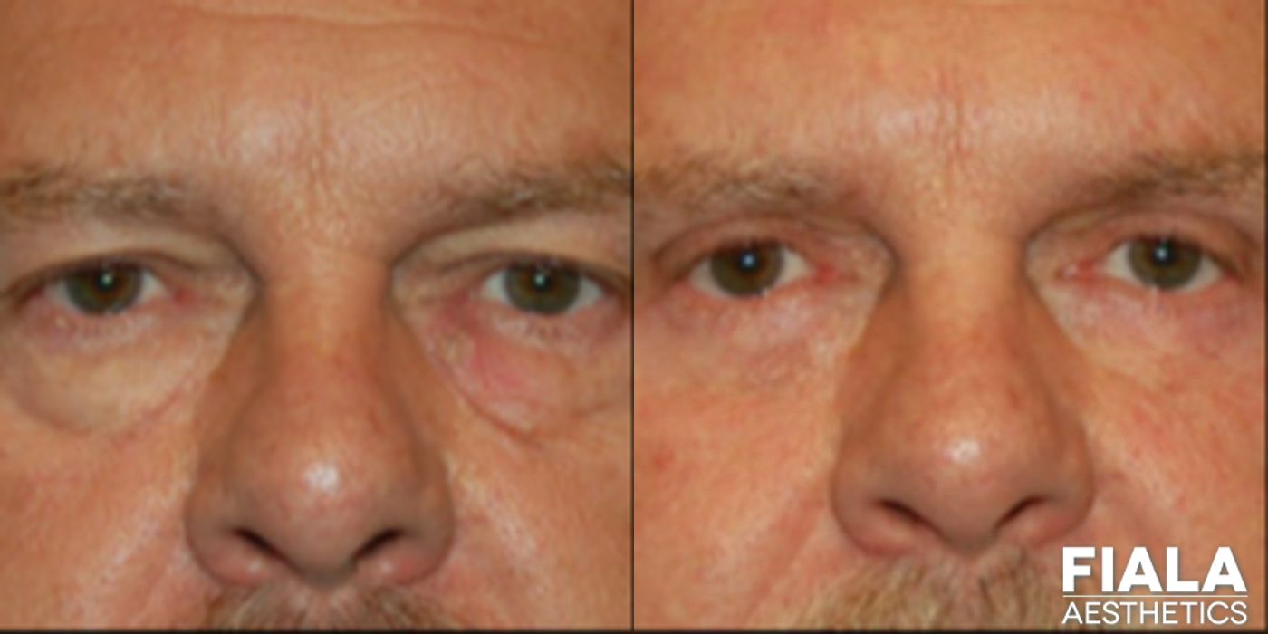 Eyelid Lift - Case 9258