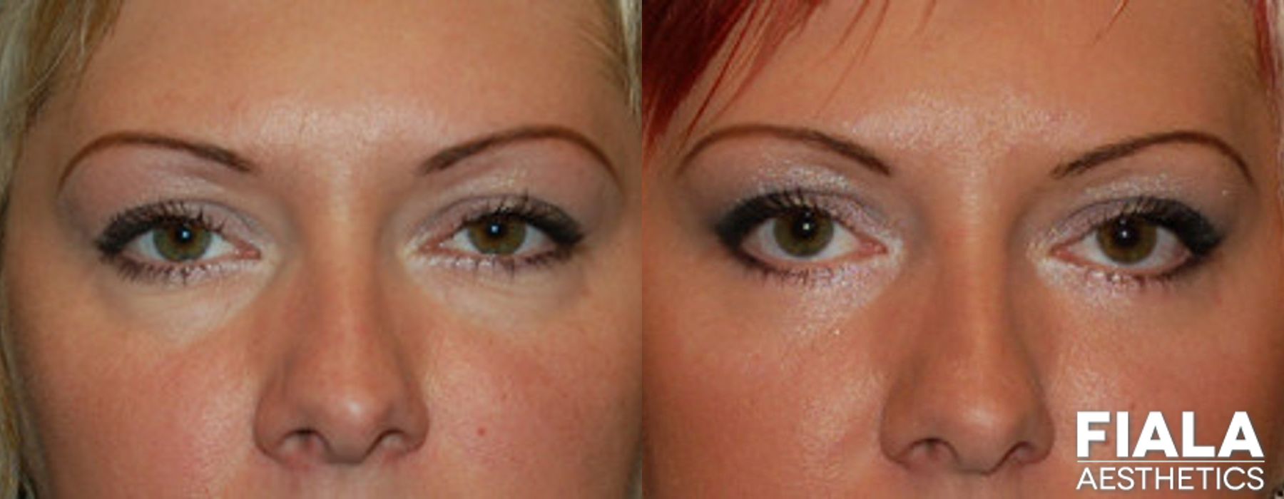 Eyelid Lift - Case 9028