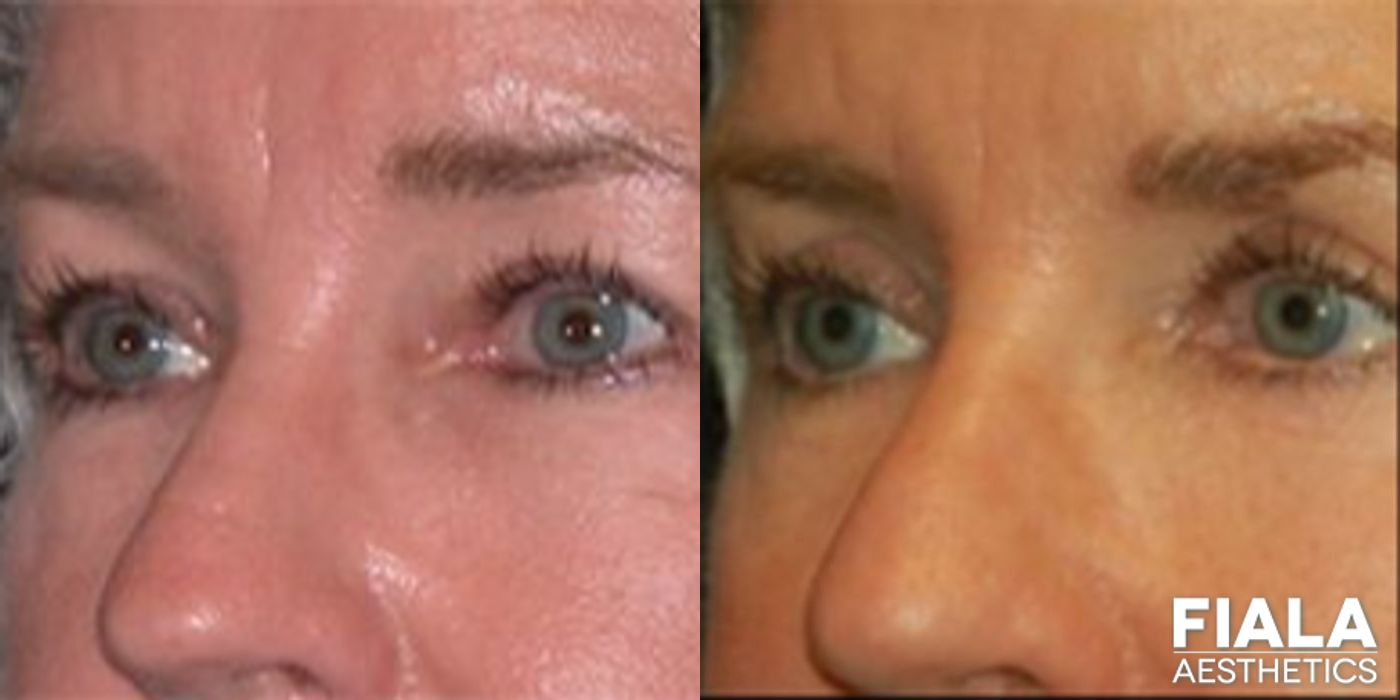 Before and after Eyelid Lift case 13873 - Angle 2