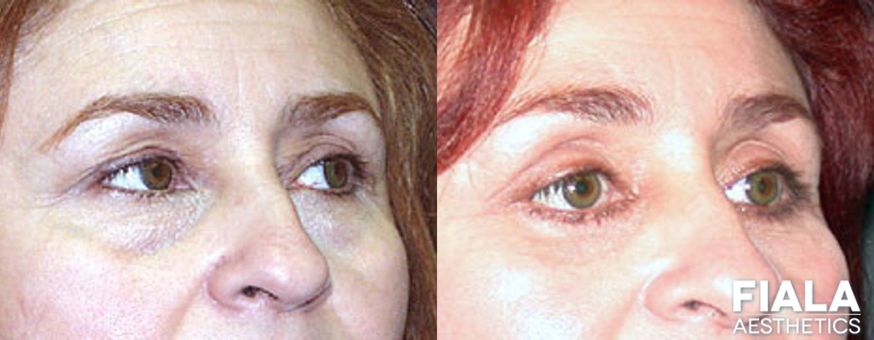 Eyelid Lift - Case 9025