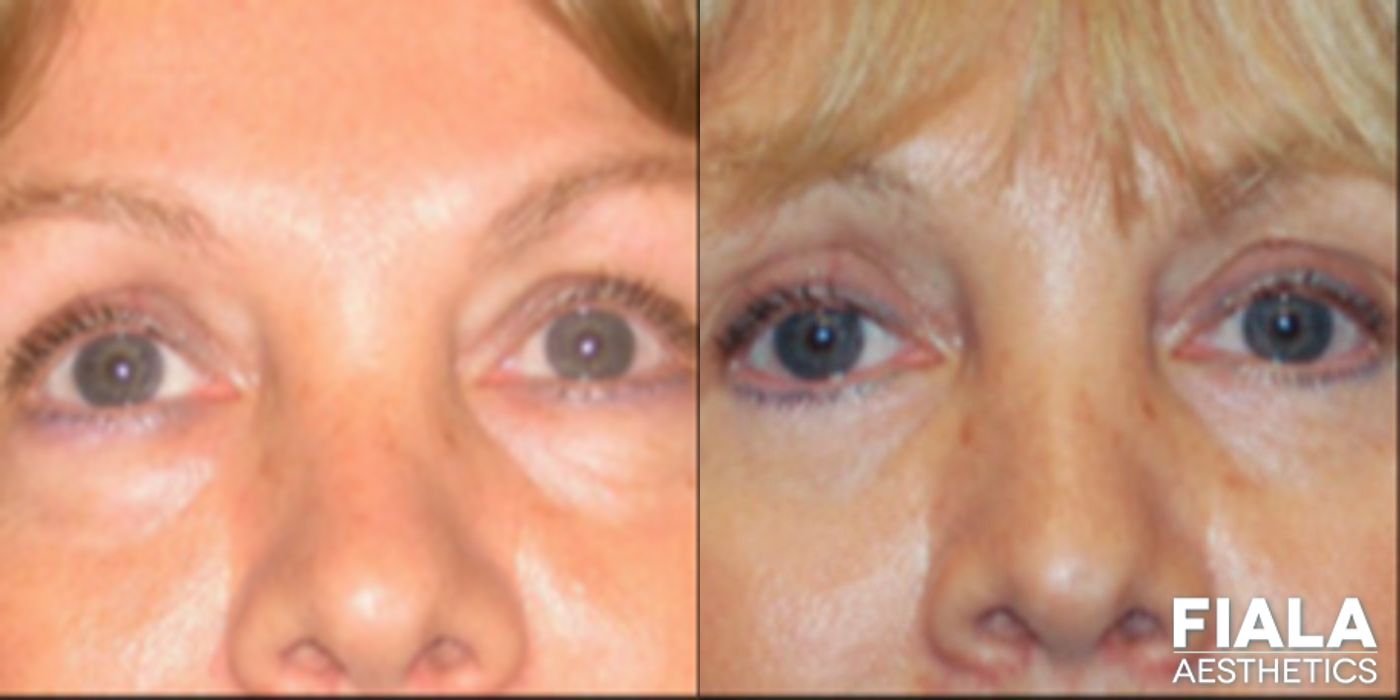 Before and after Eyelid Lift case 13867