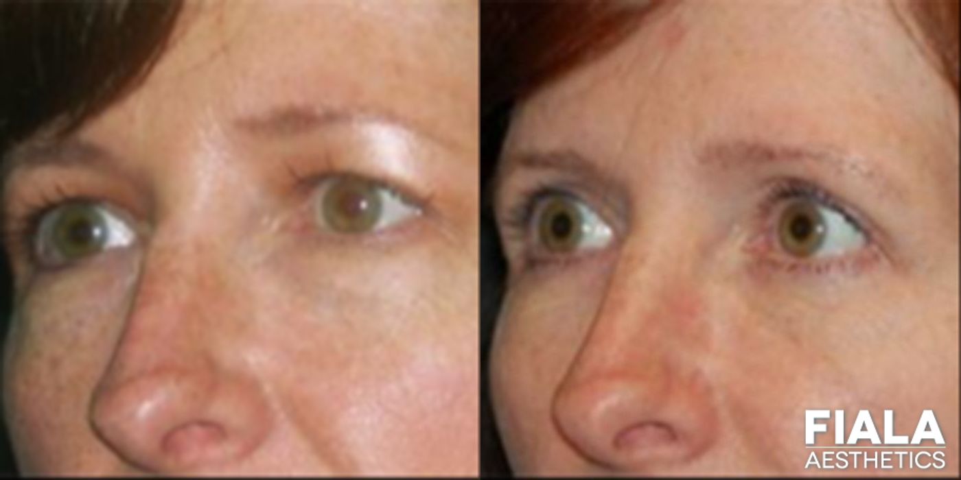 Before and after Eyelid Lift case 13866 - Angle 2