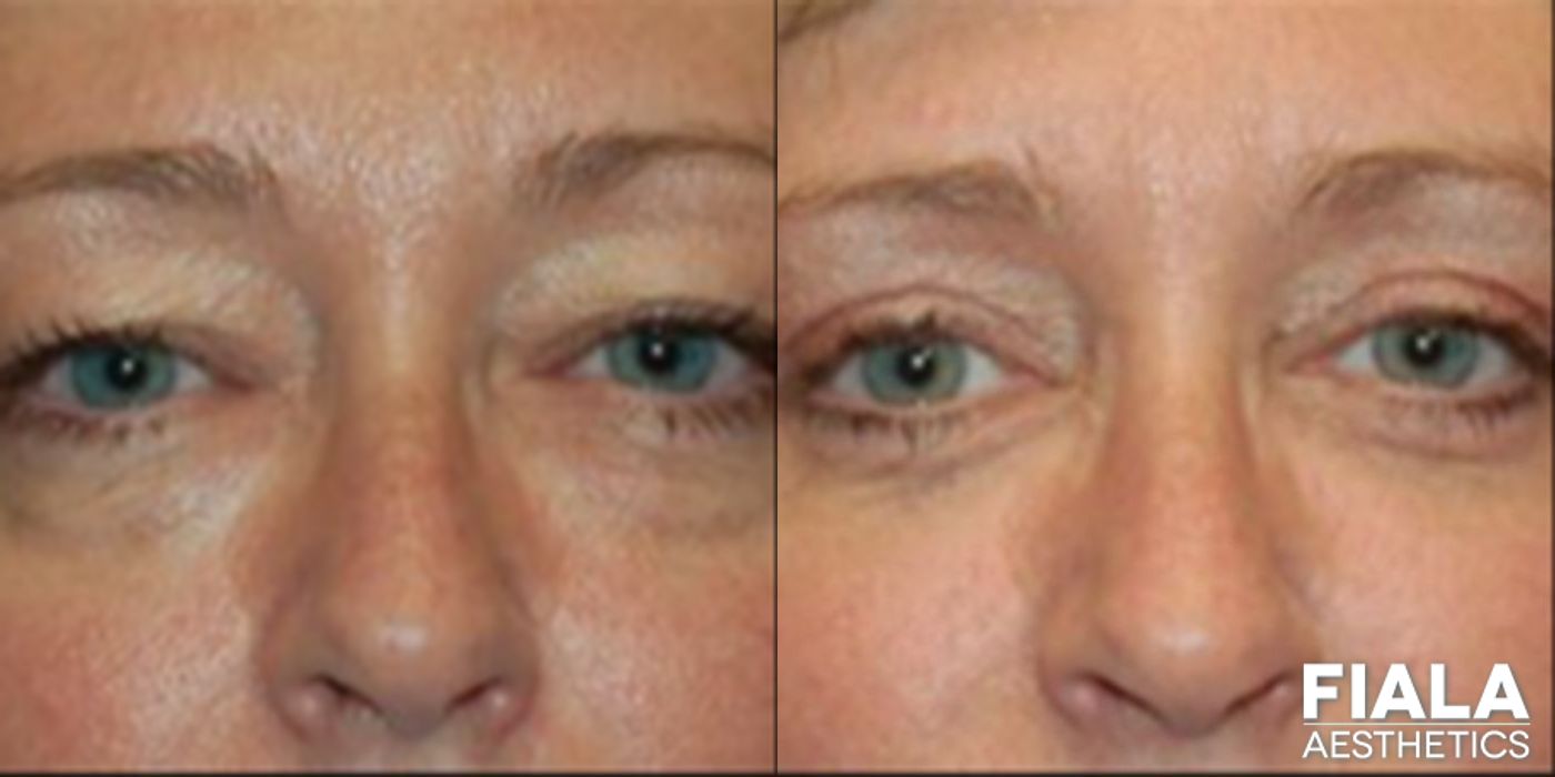 Before and after Eyelid Lift case 13869