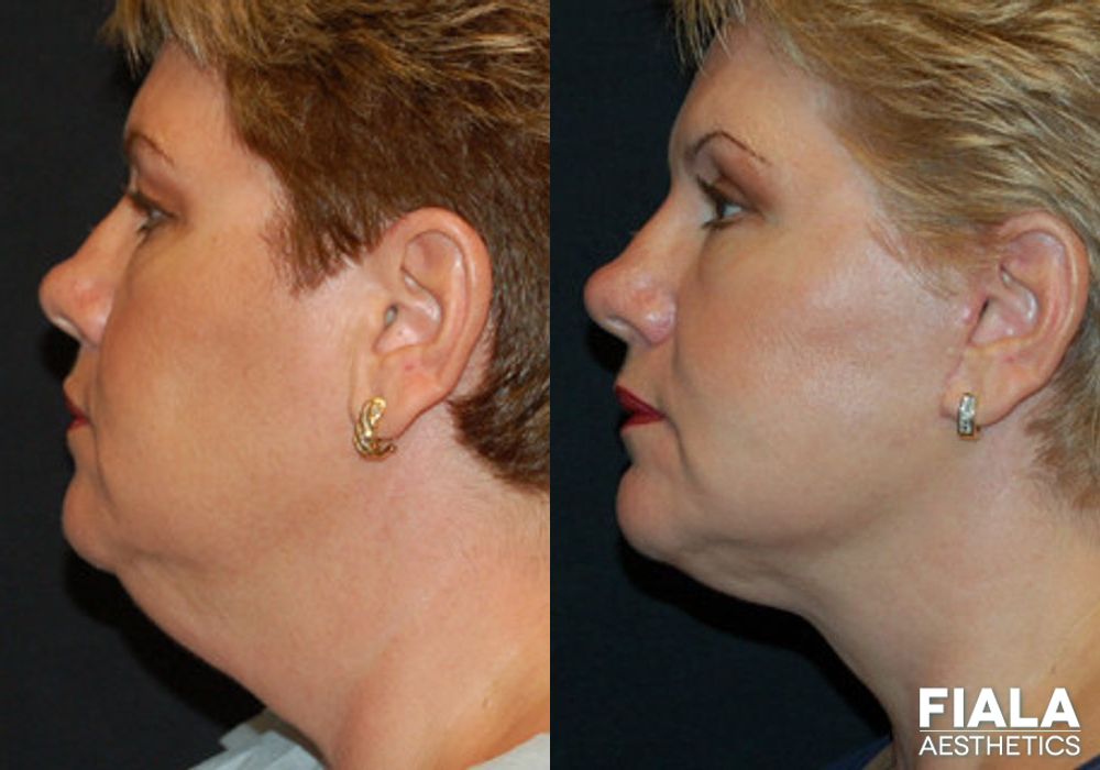 Before and after Facelift case 13898 - Angle 2