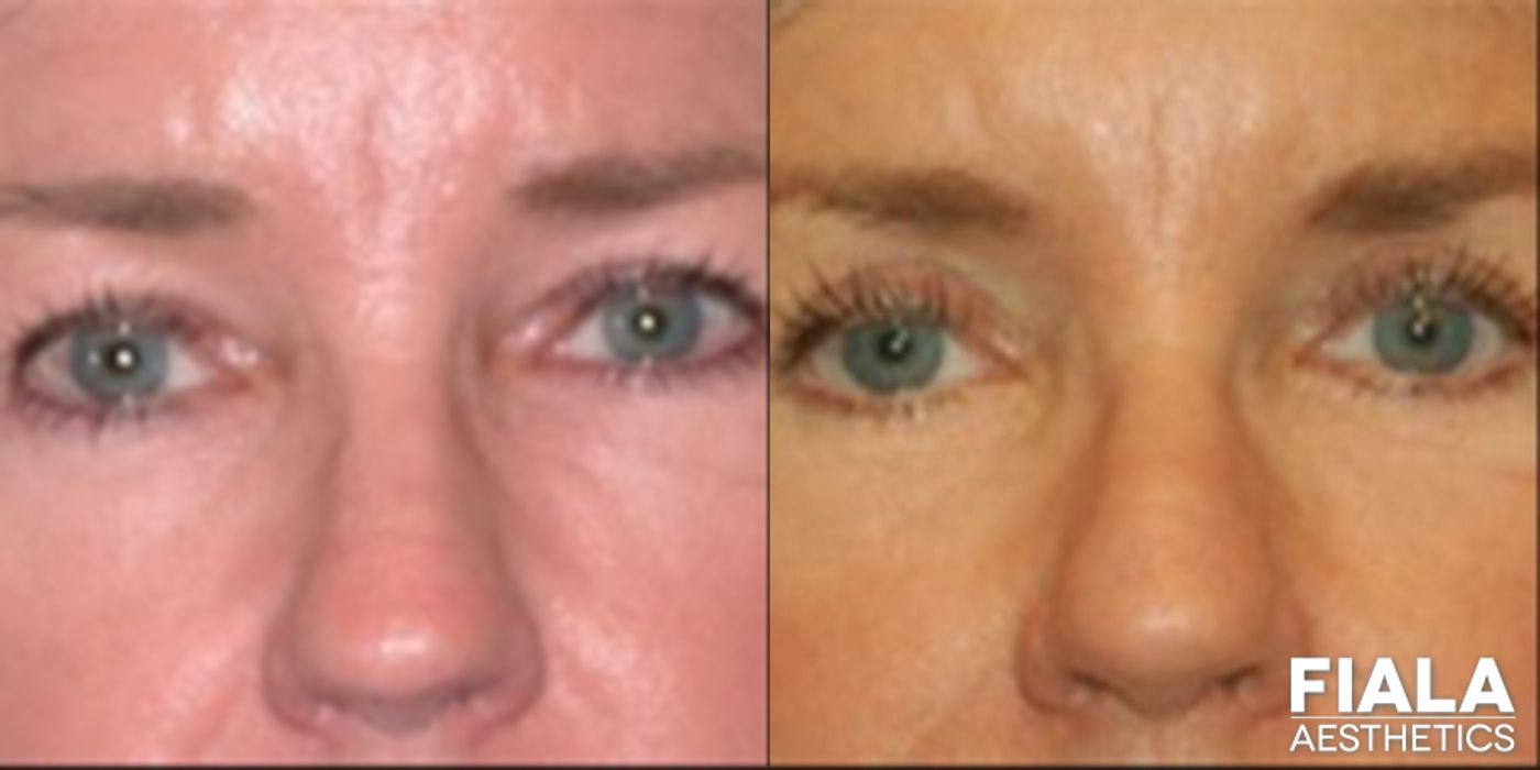 Before and after Eyelid Lift case 13873