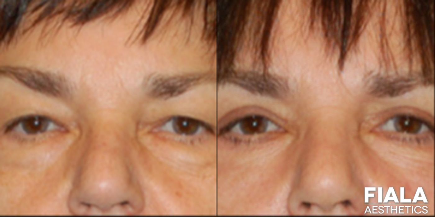 Eyelid Lift - Case 9232