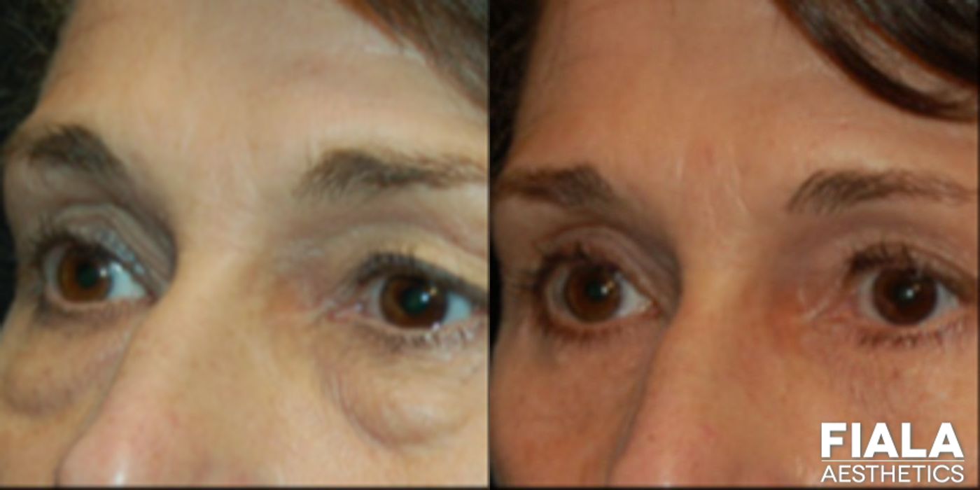 Eyelid Lift - Case 9236
