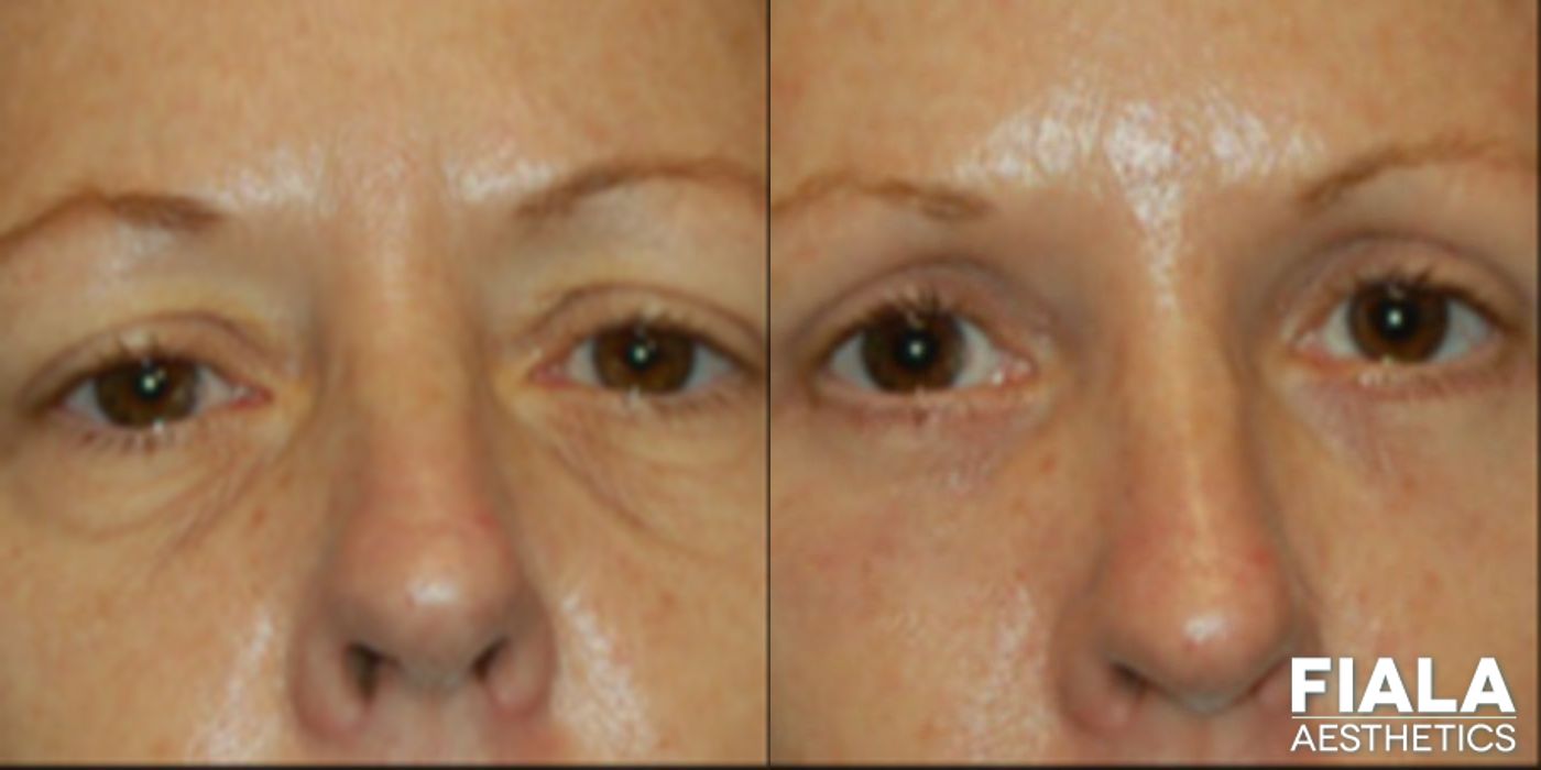 Before and after Eyelid Lift case 13868