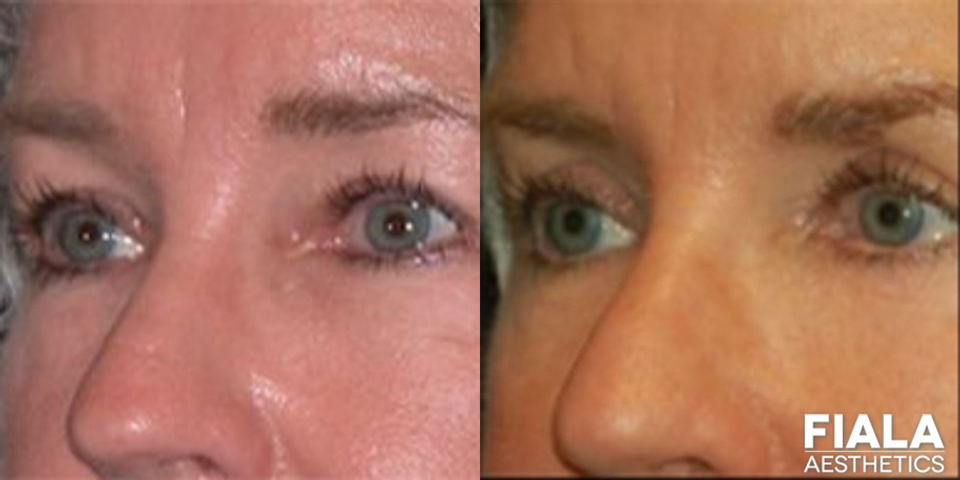 Eyelid Lift - Thumbnail 2