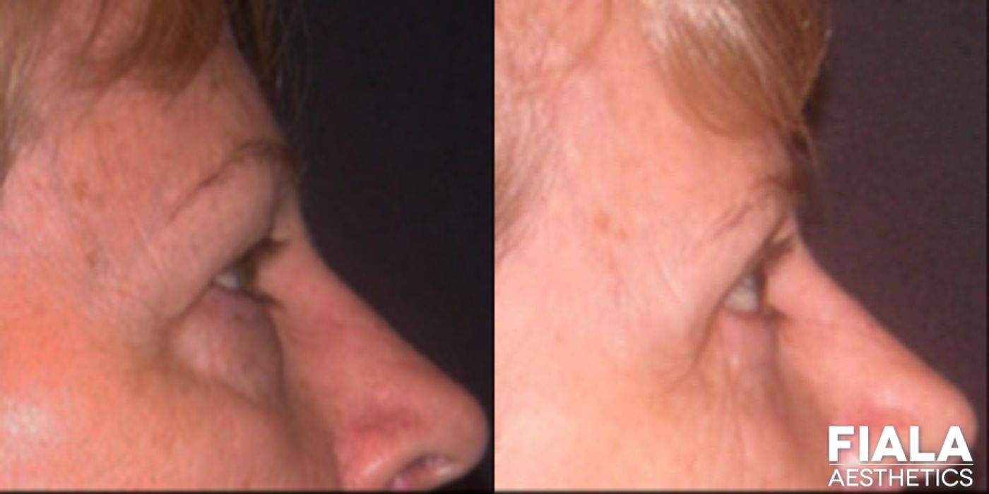 Eyelid Lift - Thumbnail 2