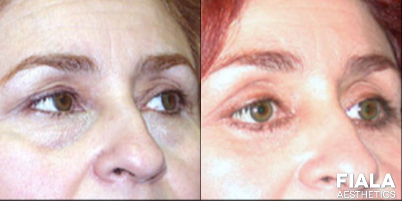 Eyelid Lift - Case 9254