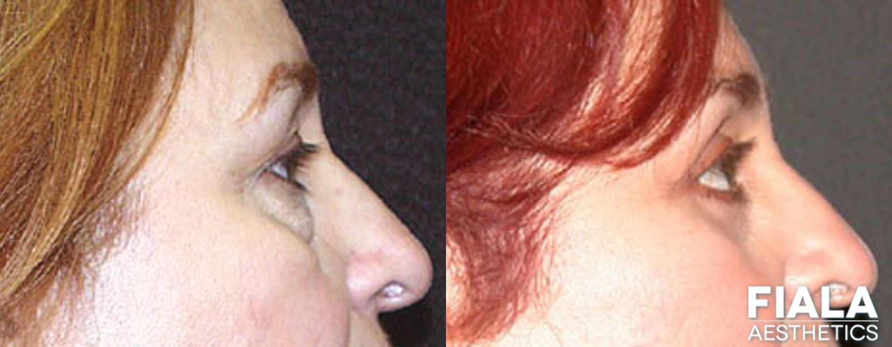 Eyelid Lift - Thumbnail 2