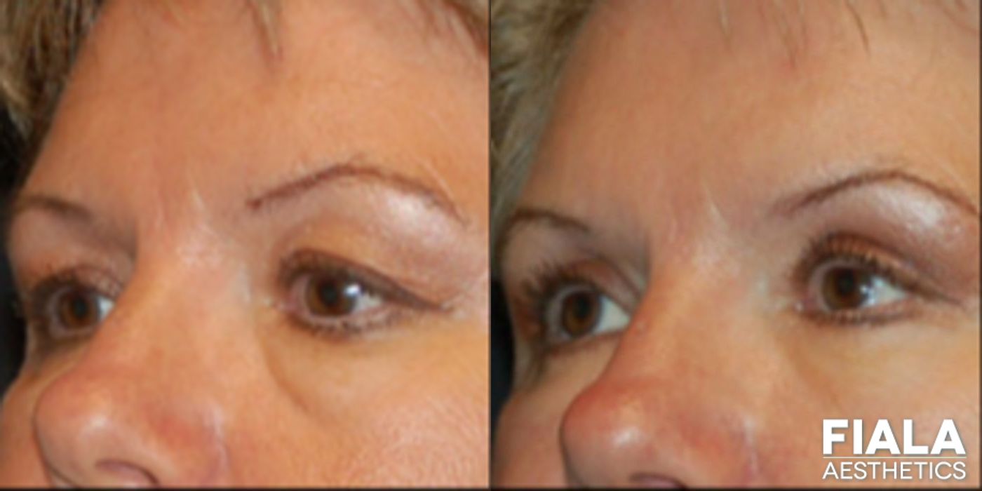 Before and after Eyelid Lift case 13881 - Angle 2