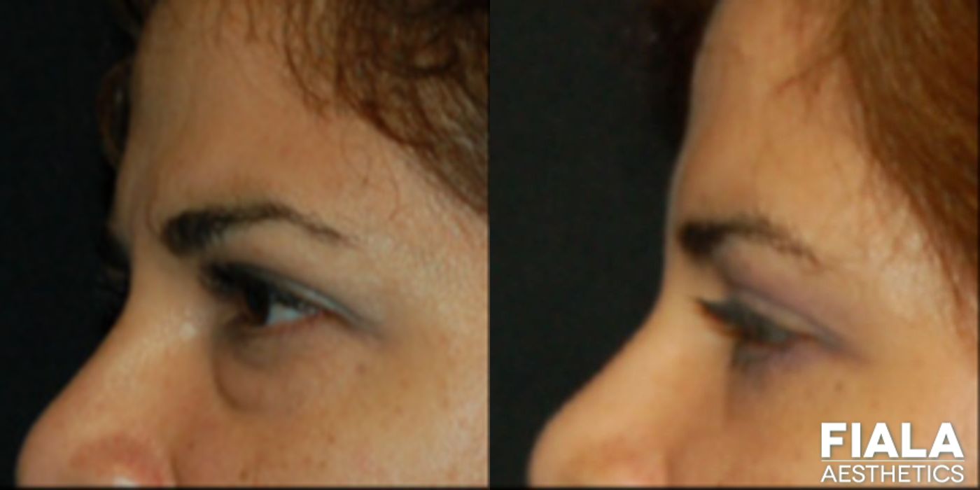 Eyelid Lift - Thumbnail 2