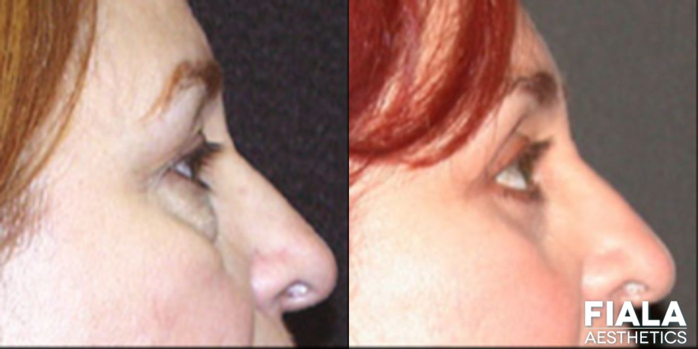 Eyelid Lift - Thumbnail 2