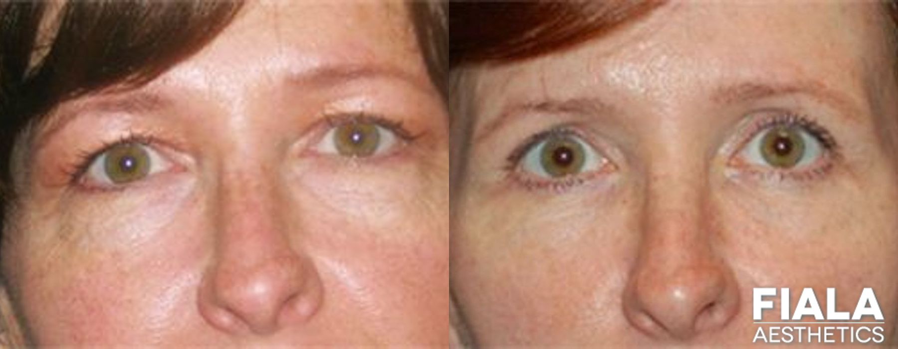 Eyelid Lift - Case 8995