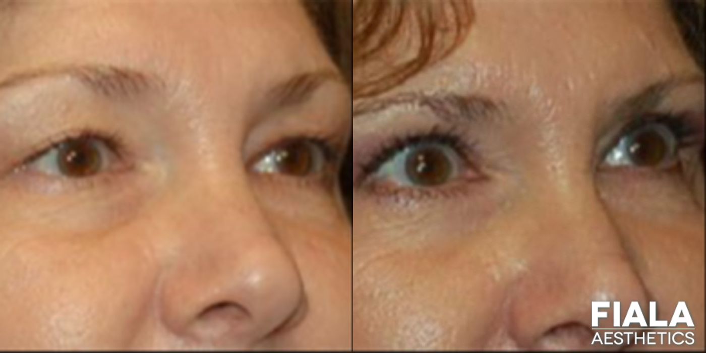 Before and after Eyelid Lift case 13871