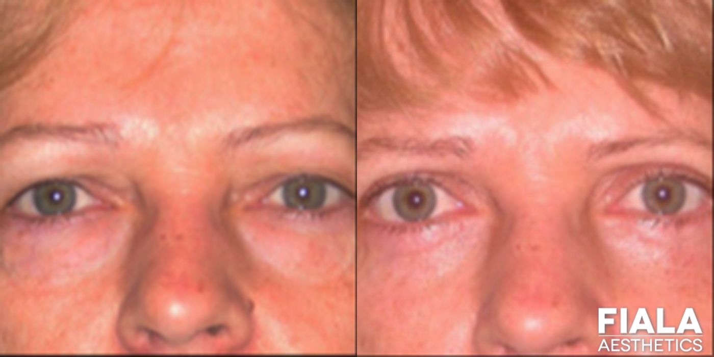 Eyelid Lift - Case 9234