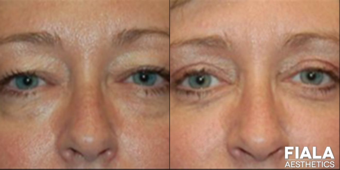 Eyelid Lift - Case 9227