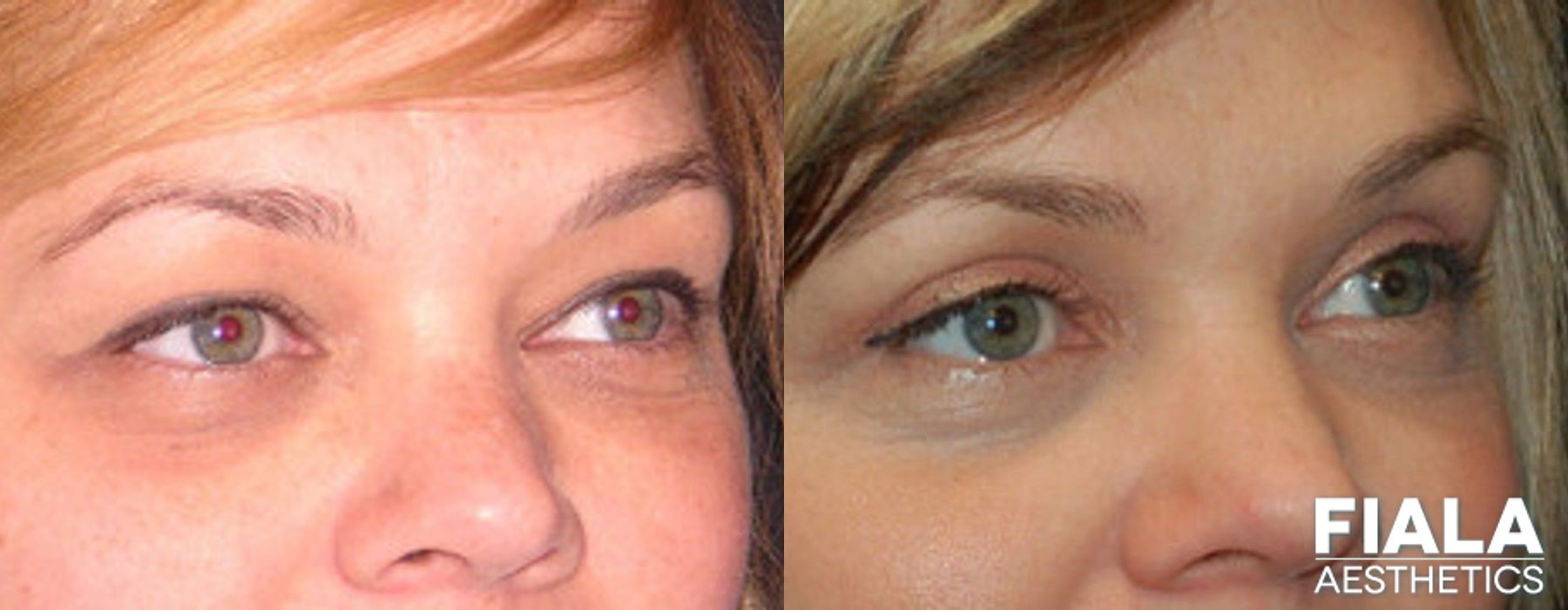 Before and after Eyelid Lift case 13874 - Angle 2