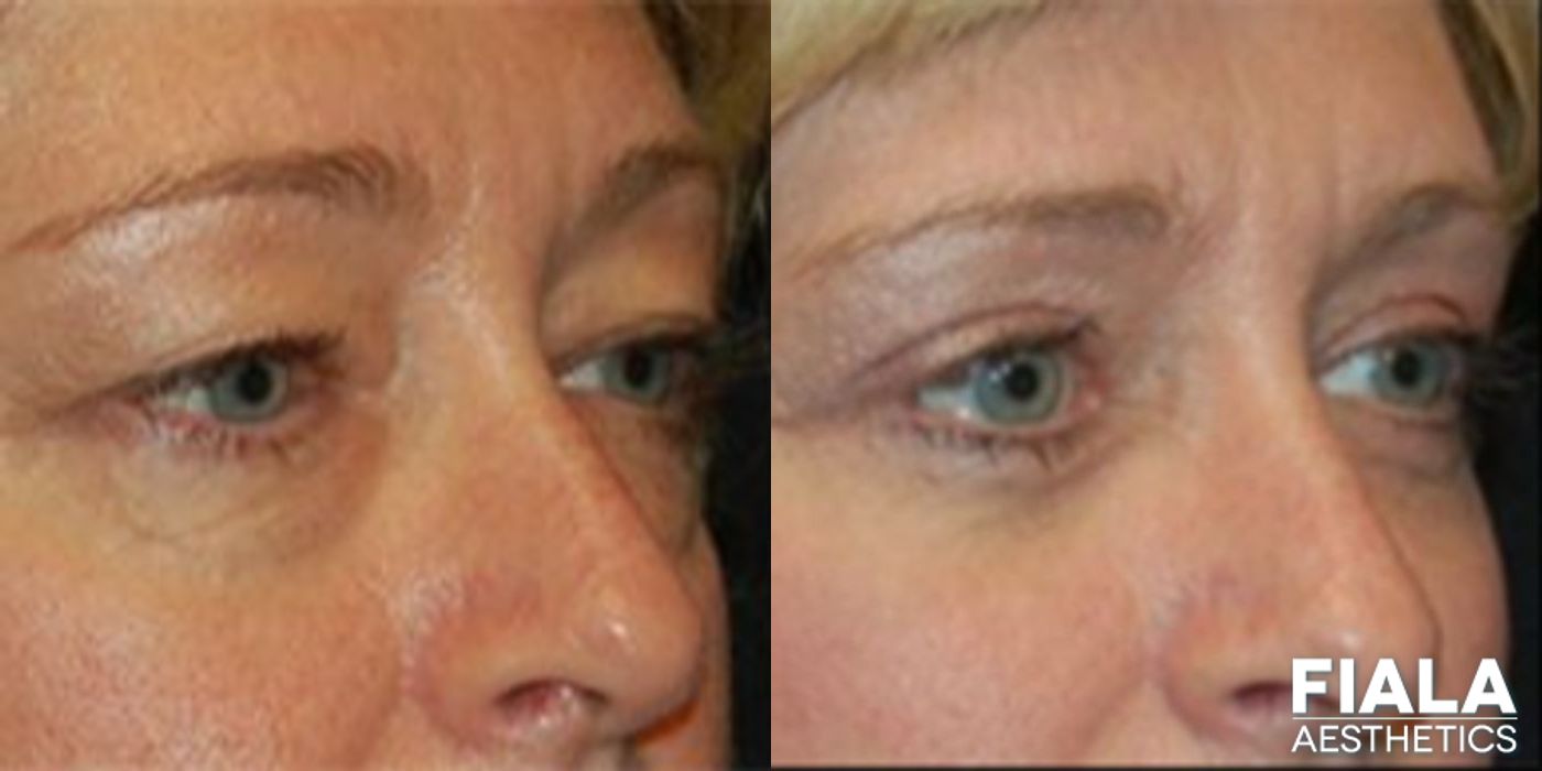 Before and after Eyelid Lift case 13869 - Angle 2