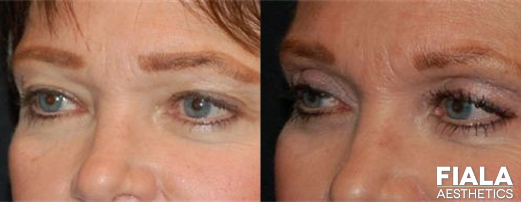 Eyelid Lift - Case 9228