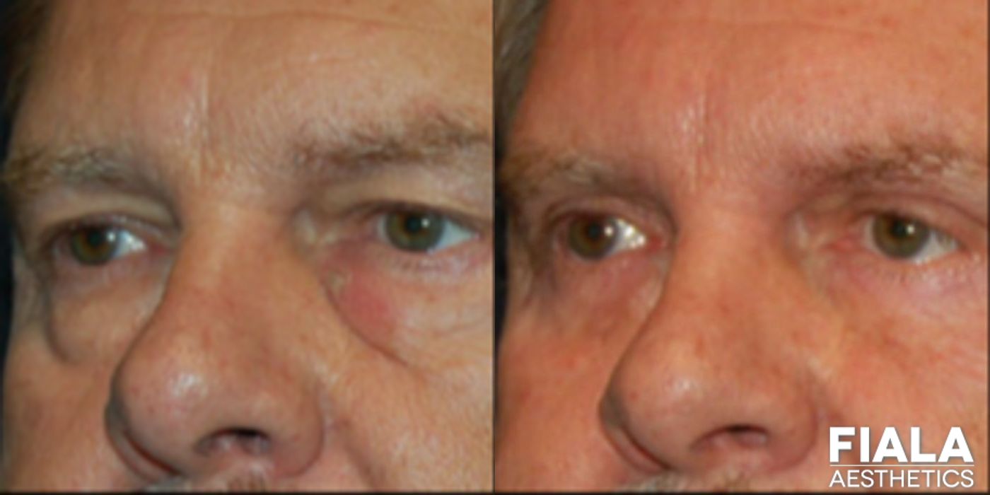 Eyelid Lift - Thumbnail 2