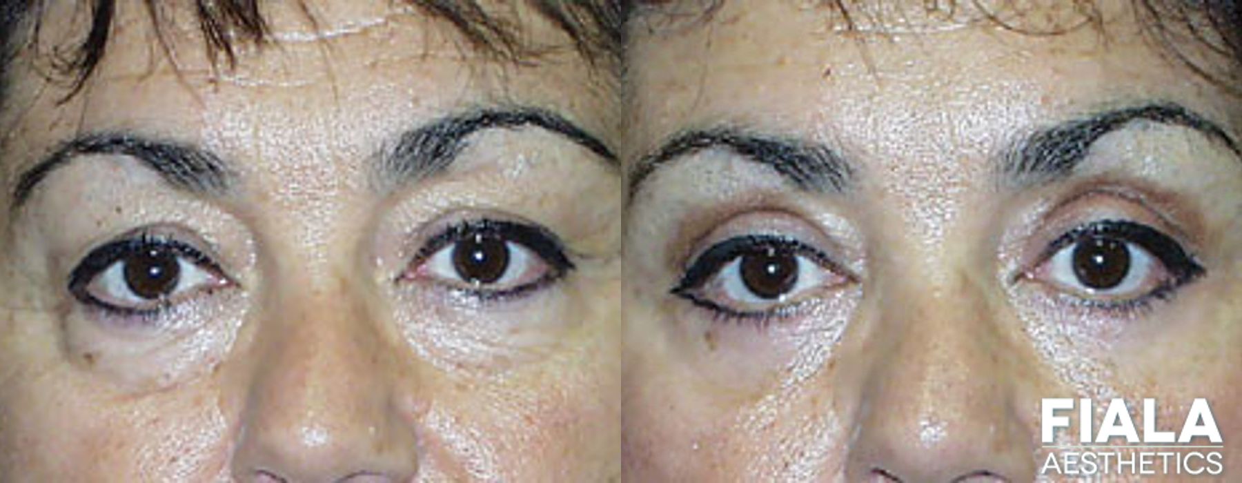 Eyelid Lift - Case 9255