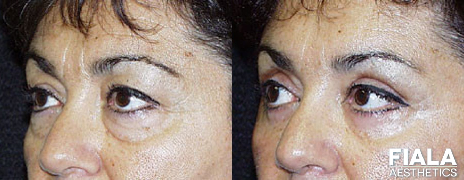 Eyelid Lift - Thumbnail 2