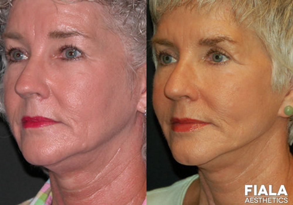 BOTOX Cosmetic - Thumbnail 2