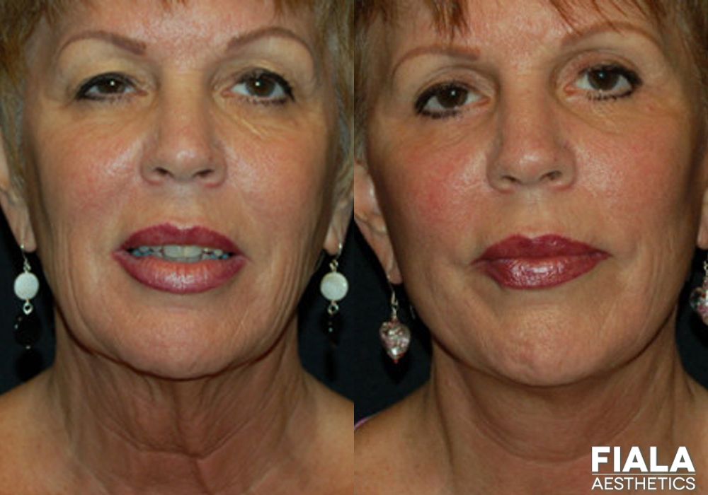 BOTOX Cosmetic - Case 9017