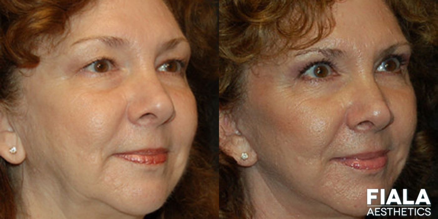 Fillers - Thumbnail 2