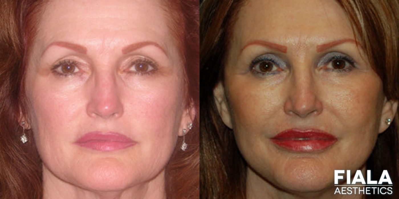 Before and after Dermal Fillers case 13892