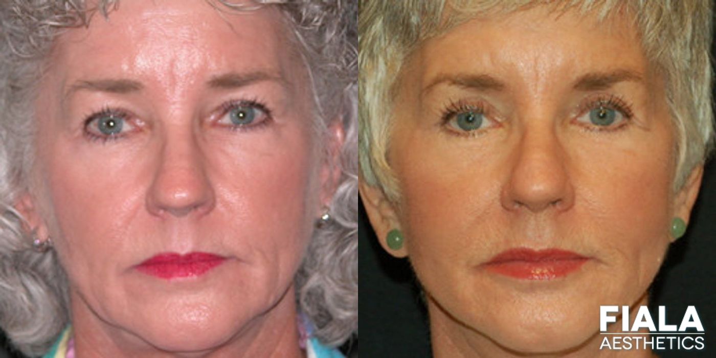 Before and after Neck Lift case 13890